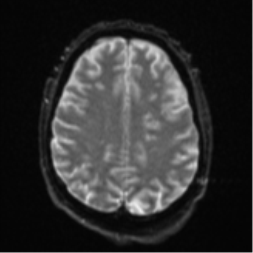 Cerebral embolic infarcts (embolic shower) (Radiopaedia 57395-64342 Axial DWI 25).png