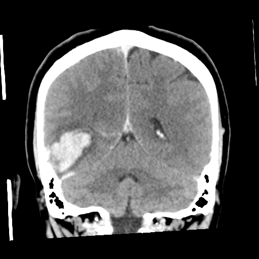 Cerebral hemorrhage secondary to arteriovenous malformation (Radiopaedia 33497-34561 C 46).png