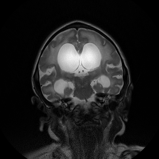 File:Cerebral manifestations of mucopolysaccharidosis type I (Radiopaedia 59171-66487 Coronal T2 12).jpg
