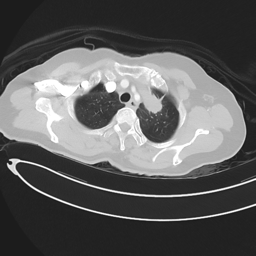 Cerebral metastases (Radiopaedia 33041-34055 Axial lung window 12).png