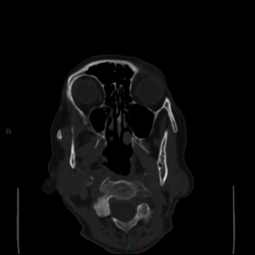 Cerebral metastases - breast primary (Radiopaedia 77653-89857 Axial bone window 3).jpg