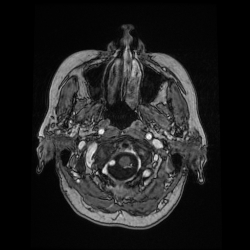 File:Cerebral metastases - melanoma (Radiopaedia 80972-94522 Axial T1 C+ 23).jpg