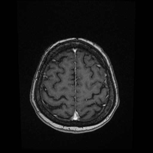 File:Cerebral metastases - melanoma (Radiopaedia 80972-94522 Axial T1 C+ 77).jpg