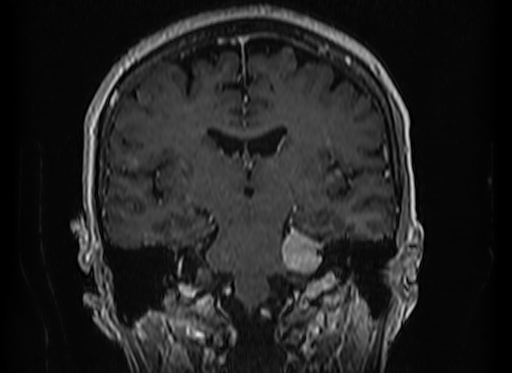 Cerebral metastases from lung cancer with amyloid angiopathy and cerebellopontine angle meningioma (Radiopaedia 74306-85191 Coronal T1 C+ 32).jpg