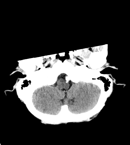File:Cerebral metastasis (Radiopaedia 46744-51260 Axial C+ delayed 5).png
