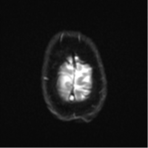 Cerebral metastasis - colorectal adenocarcinoma (Radiopaedia 50394-55765 Axial DWI 26).png