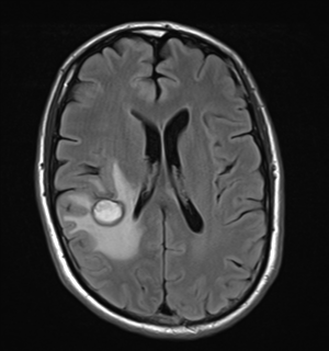 File:Cerebral metastasis - melanoma (Radiopaedia 54718-60954 Axial FLAIR 18).png