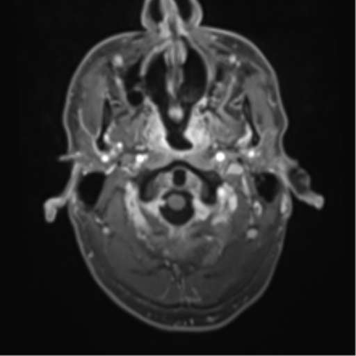 Cerebral metastasis - melanoma (Radiopaedia 54718-60954 Axial T1 C+ fat sat 4).png