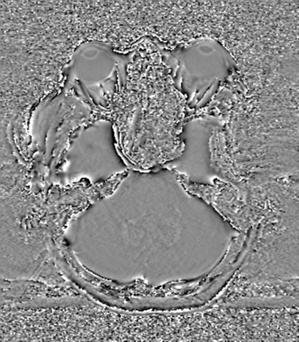 Cerebral metastasis to basal ganglia (Radiopaedia 81568-95413 Axial SWI phase 20).png