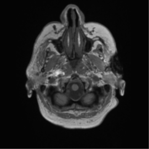 File:Cerebral metastasis to basal ganglia (Radiopaedia 81568-95413 Axial T1 4).png