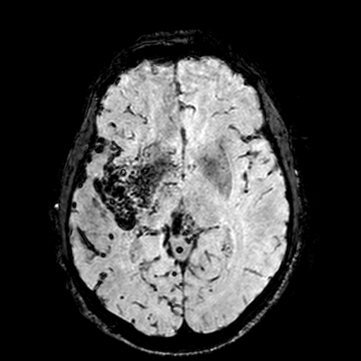 Cerebral parenchymal arteriovenous malformation (Radiopaedia 27280-27456 Axial SWI 56).jpg