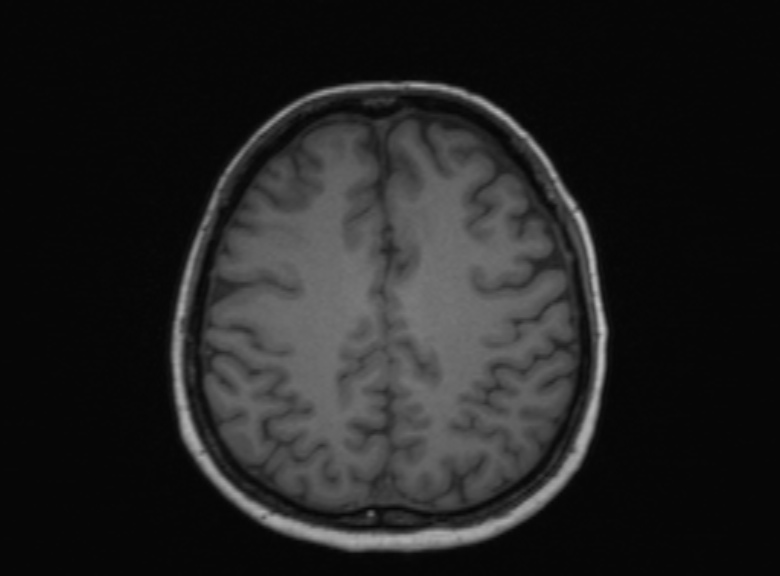 Cerebral ring enhancing lesions - cerebral metastases (Radiopaedia 44922-48817 Axial T1 172).jpg