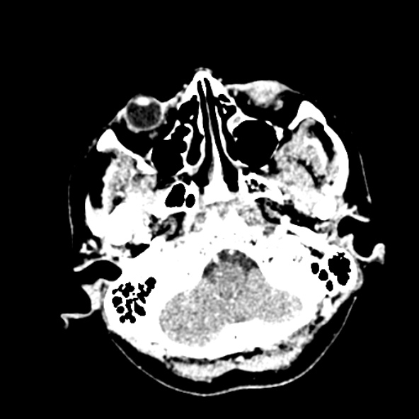 Cerebral ring enhancing lesions - cerebral metastases (Radiopaedia 44922-48818 B 43).jpg