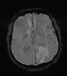 File:Cerebral toxoplasmosis (Radiopaedia 43956-47461 Axial SWI 21).jpg