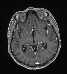 Cerebral toxoplasmosis (Radiopaedia 43956-47461 Axial T1 C+ 32).jpg