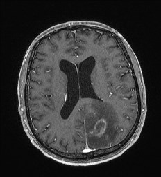 Cerebral toxoplasmosis (Radiopaedia 43956-47461 Axial T1 C+ 45).jpg