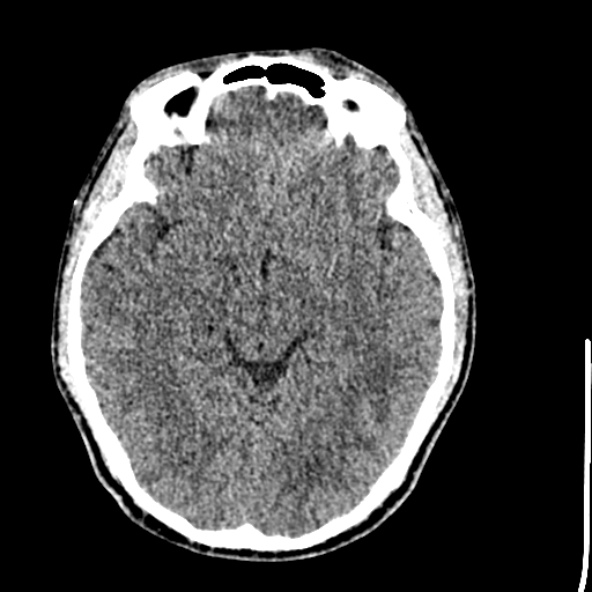 Cerebral toxoplasmosis (Radiopaedia 53993-60131 Axial non-contrast 35).jpg