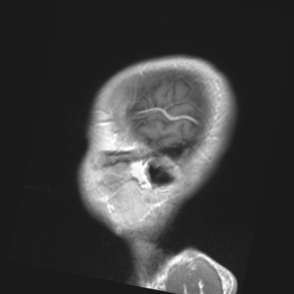 File:Cerebral toxoplasmosis (Radiopaedia 53993-61435 Coronal T1 5).jpg
