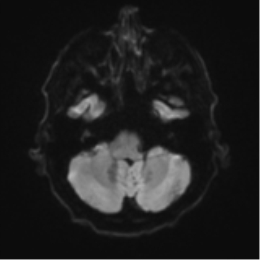 Cerebral toxoplasmosis (Radiopaedia 54575-60804 Axial DWI 41).png