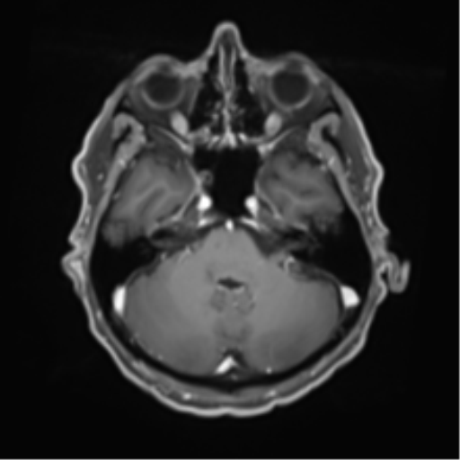 Cerebral toxoplasmosis (Radiopaedia 54575-60804 Axial T1 C+ 16).png
