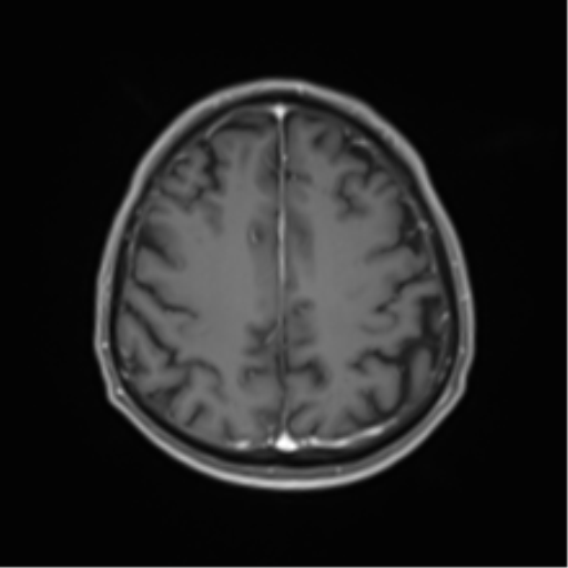Cerebral toxoplasmosis (Radiopaedia 54575-60804 Axial T1 C+ 41).png