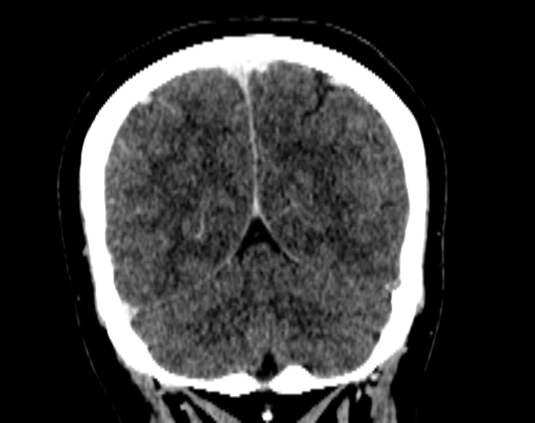 Cerebral venous hemorrhagic infarct from venous sinus thrombosis (Radiopaedia 55433-61883 Coronal C+ delayed 47).jpg