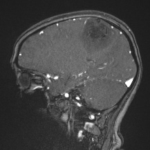 Cerebral venous infarction - hemorrhagic (Radiopaedia 81625-95505 Sagittal MRV 29).jpg