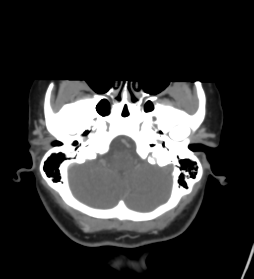 Cerebral venous infarction due to transverse sinus thrombosis (Radiopaedia 34688-36120 Axial CT venogram 11).png