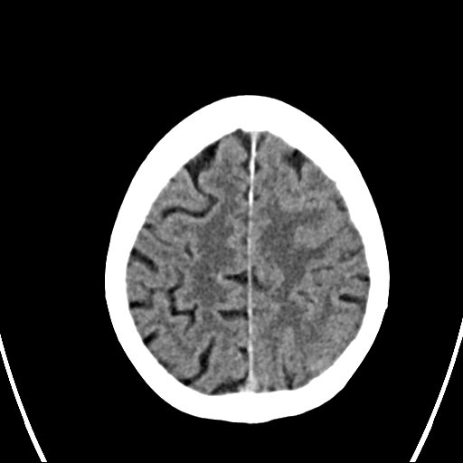 File:Cerebral venous infarction with hemorrhage (Radiopaedia 65343-74381 Axial non-contrast 21).jpg