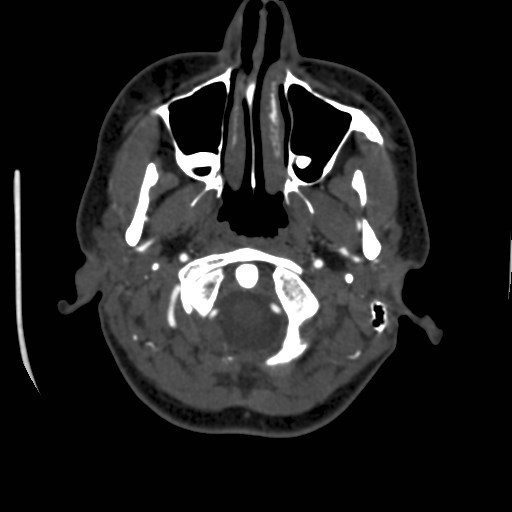 Cerebral venous sinus thrombosis (Radiopaedia 40619-43227 A 16).jpg