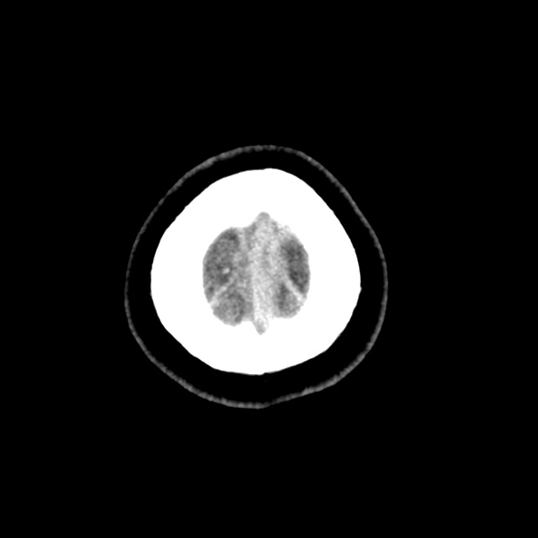 Cerebral venous sinus thrombosis (Radiopaedia 59224-66551 Axial non-contrast 60).jpg