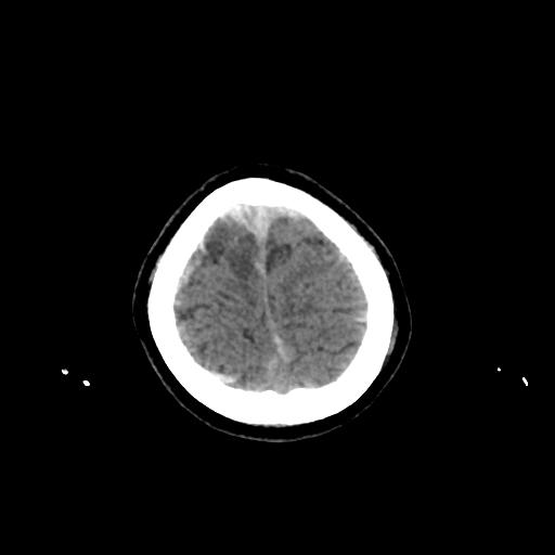 Cerebral venous throbmosis - hemorrhagic venous infarction (Radiopaedia 87318-103613 Axial non-contrast 158).jpg