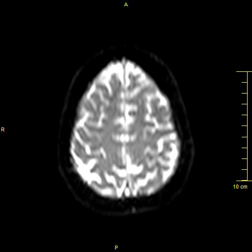 File:Cerebral venous thrombosis (Radiopaedia 23288-23351 Axial DWI 36).JPG
