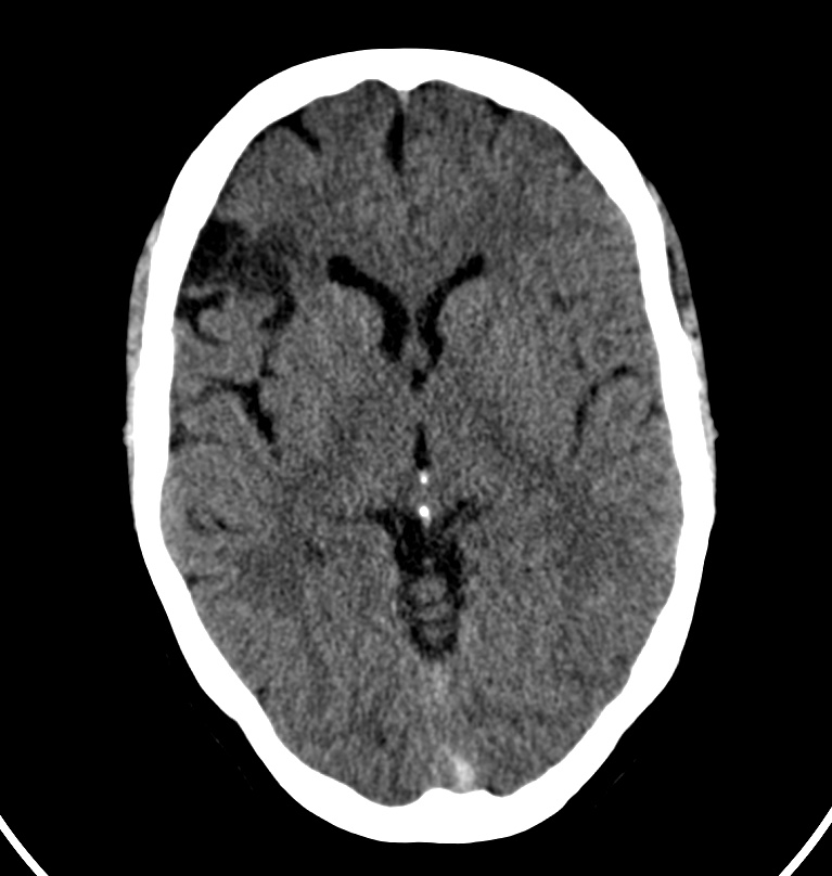 Cerebral venous thrombosis - CT only (Radiopaedia 41031-43778 Axial non-contrast 45).jpg