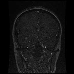 Cerebral venous thrombosis - ulcerative colitis (Radiopaedia 66049-75219 Coronal MRV 74).jpg