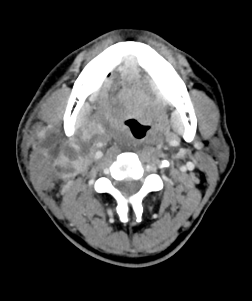 Cervical abscess (Radiopaedia 43725-47184 A 25).png