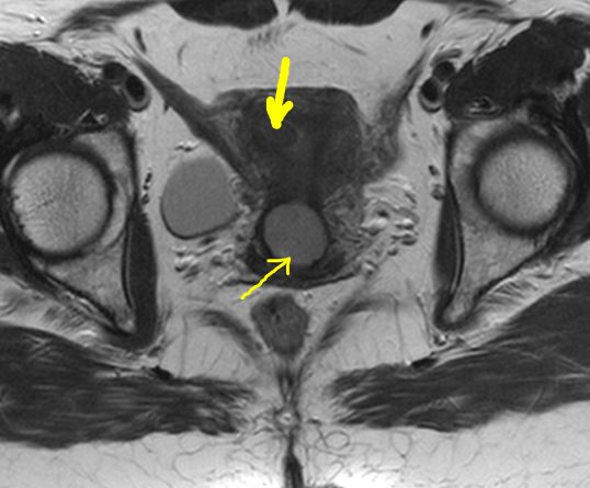 File:Cervical adenocarcinoma (Radiopaedia 65011-74267 Axial 1).JPG