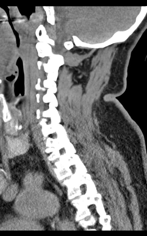 Cervical canal stenosis - OPLL and osteophytes (Radiopaedia 47329-51910 B 31).png