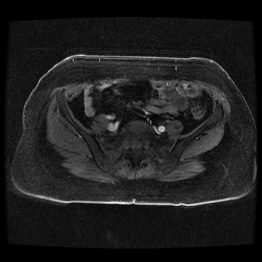 File:Cervical carcinoma (Radiopaedia 70924-81132 Axial T1 C+ fat sat 74).jpg