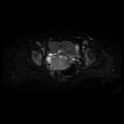 Cervical carcinoma (Radiopaedia 88010-104555 Axial DWI 10).jpg
