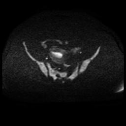 Cervical carcinoma (Radiopaedia 88010-104555 Axial DWI 76).jpg