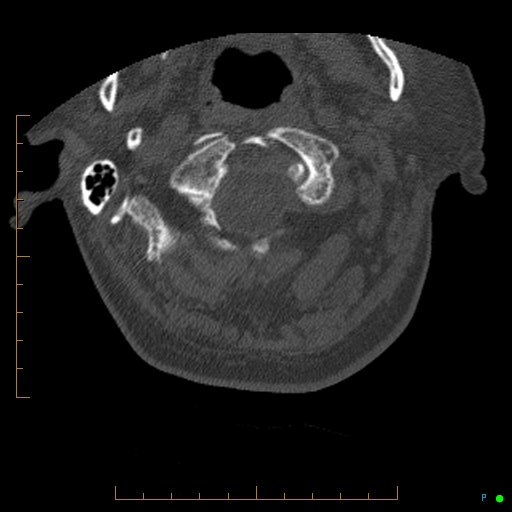 Cervical spine fracture - ankylosing spondylitis (Radiopaedia 76835-88706 Axial bone window 17).jpg