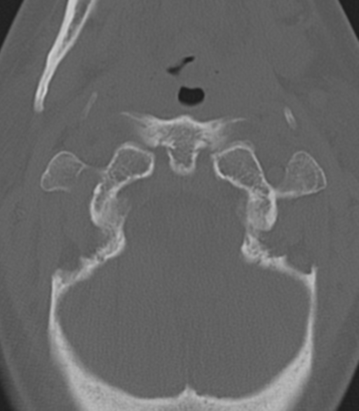 File:Cervical spine fractures with vertebral artery dissection (Radiopaedia 53296-59268 Axial bone window 13).png