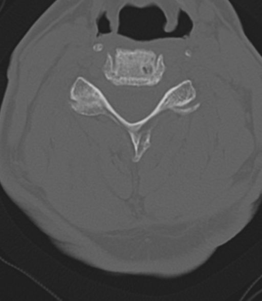 File:Cervical spine fractures with vertebral artery dissection (Radiopaedia 53296-59268 Axial bone window 30).png