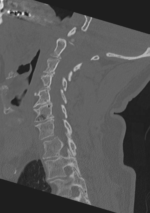Cervical spine fractures with vertebral artery dissection (Radiopaedia 53296-59268 Sagittal bone window 41).png