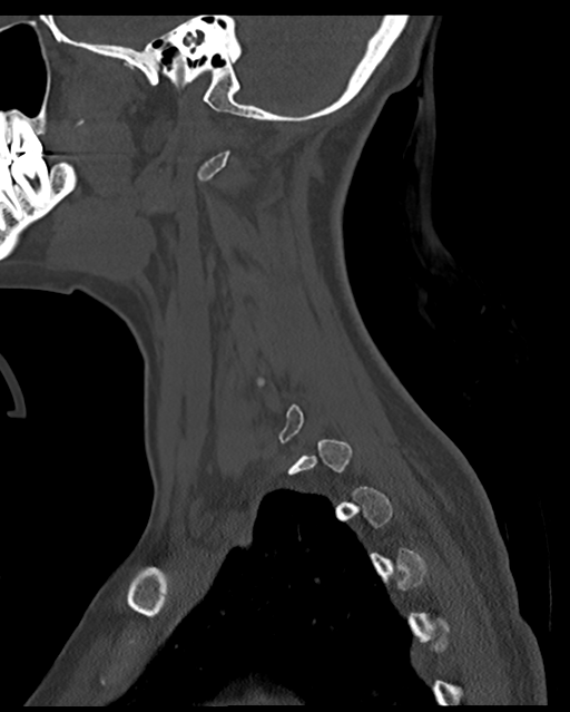 Cervical tuberculous spondylitis (Radiopaedia 39149-41365 Sagittal bone window 16).png