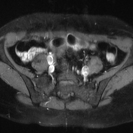 File:Cesarian section scar endometriosis (Radiopaedia 66520-75799 Axial T1 fat sat 2).jpg