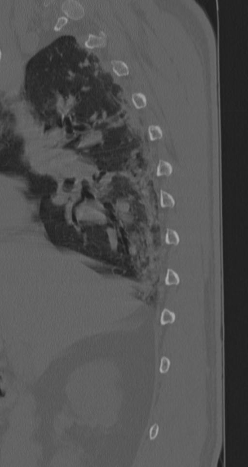 Chance fracture (Radiopaedia 33854-35020 Sagittal bone window 71).png
