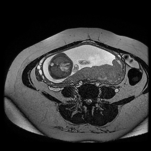 Chiari II malformation - fetal MRI (Radiopaedia 68099-77581 Axial Fiesta 21).jpg