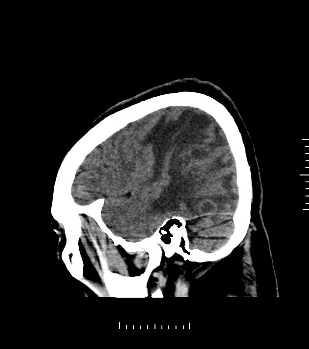 Cholangiocarcinoma with cerebral metastases (Radiopaedia 83519-98628 C 9).jpg